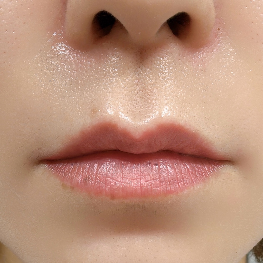 人中長いのが気になってるけど、唇ヒアルロン酸とリップアートどっちがいいかな？