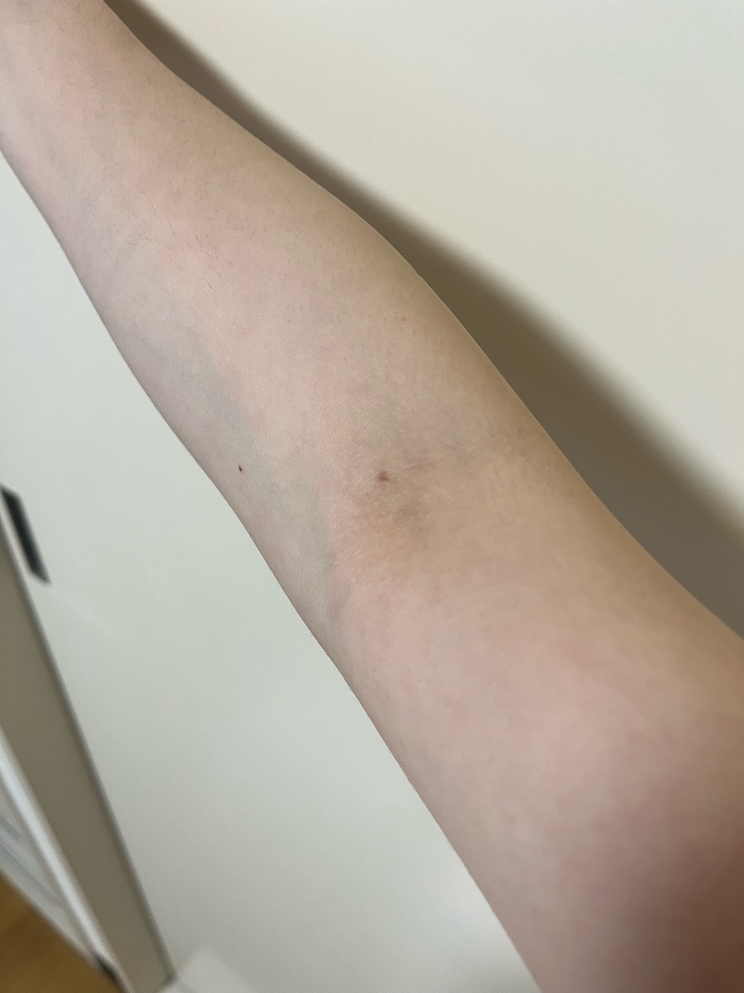 注射跡はどうしたらきれいに治りますか？