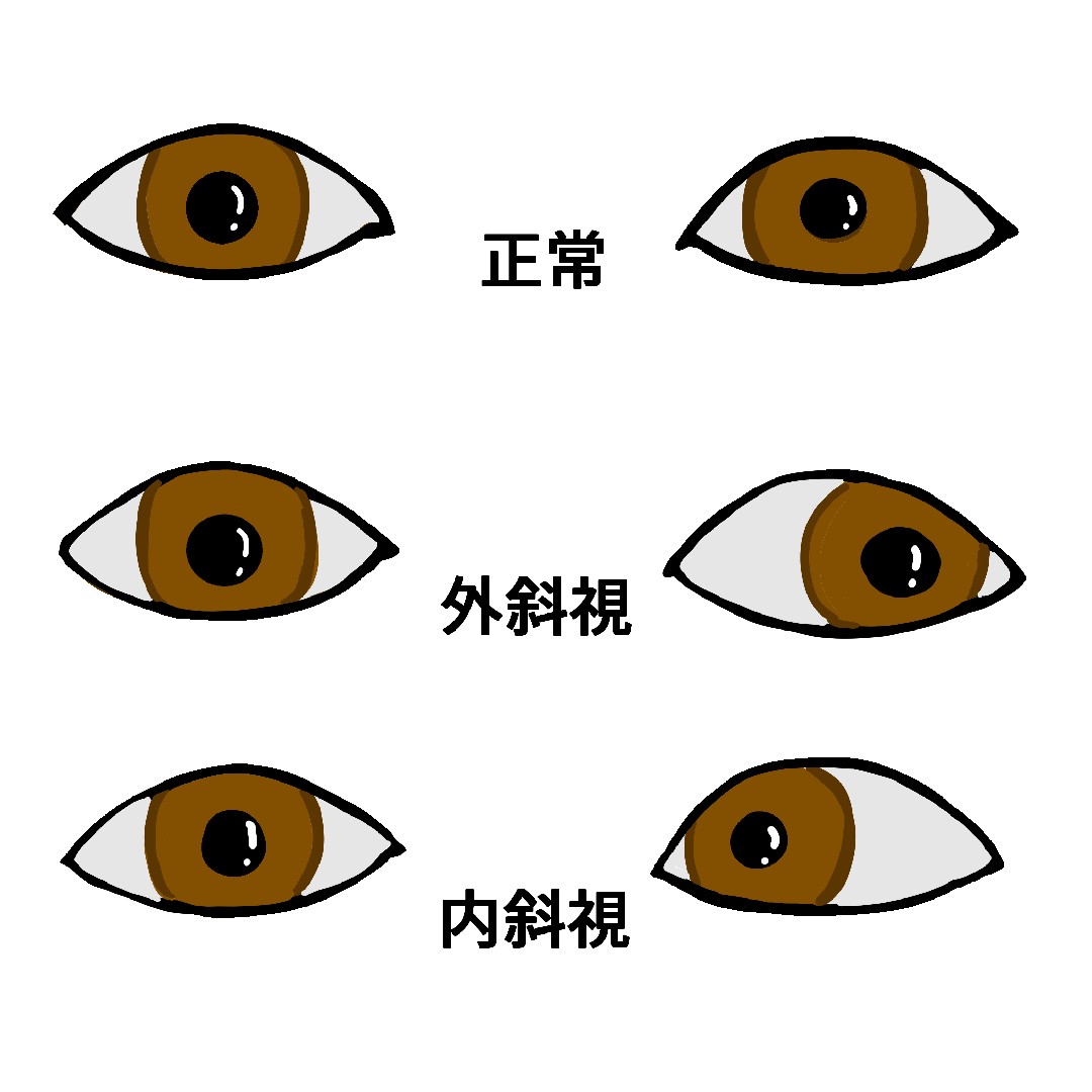 斜視の星